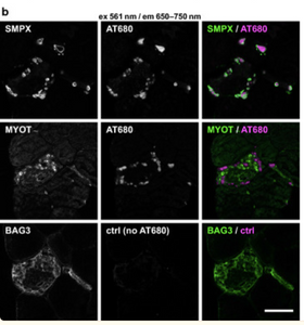 Amytracker confirms amyloid nature of inclusion bodies in muscle linked to gene mutations